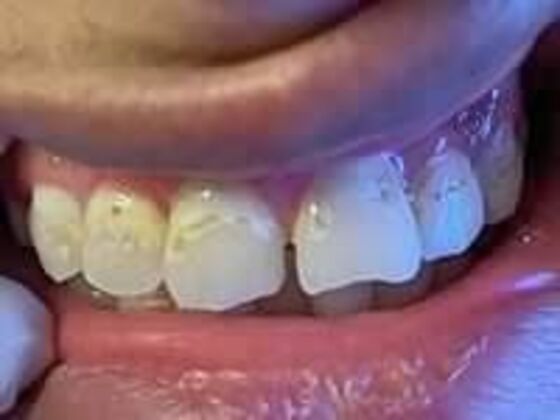 Composite Fillings Case 2 - Before