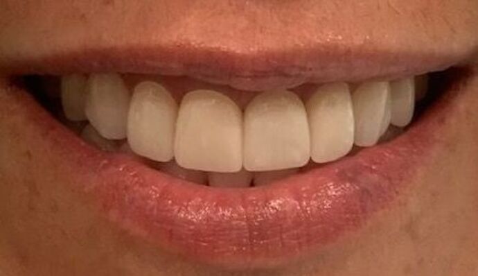 Crowns Case 2 - After