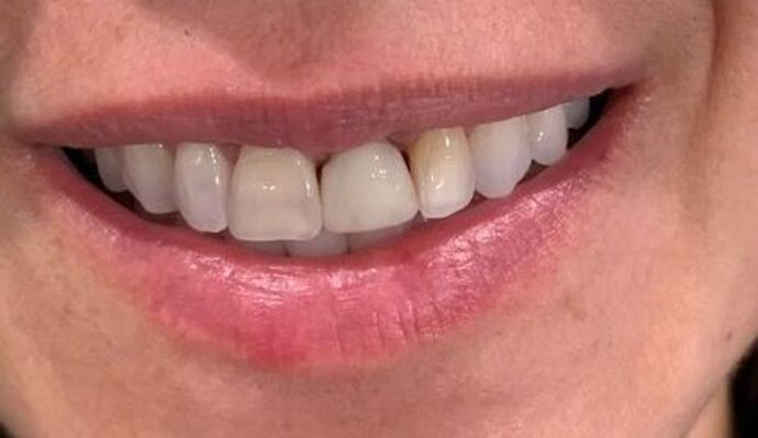 Crowns Case 2 - Before