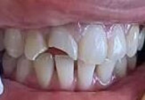 Composite Fillings: Case 3 - Before