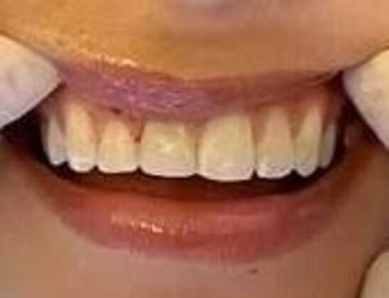 Composite Fillings: Case 3 - After