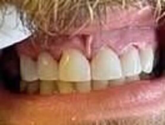 Crowns Case 3 - After