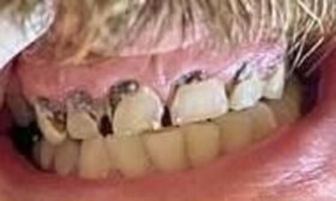 Crowns Case 3 - Before