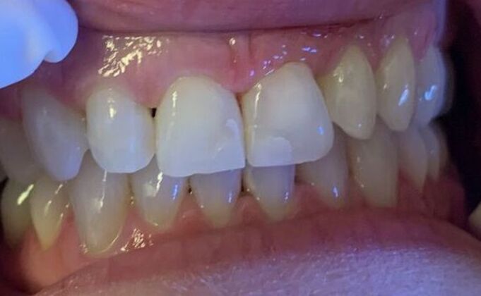 Veneers Case 1 - Before