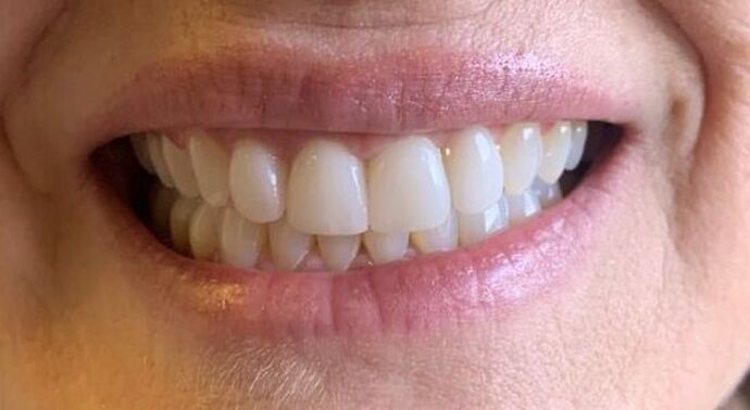 Veneers Case 1 - After