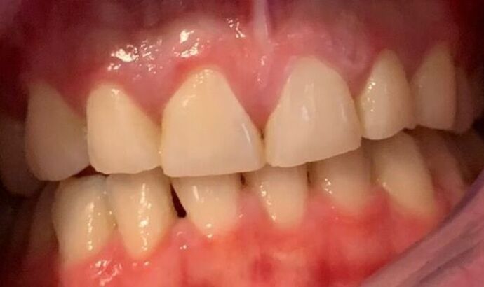 Veneers Case 2 - Before