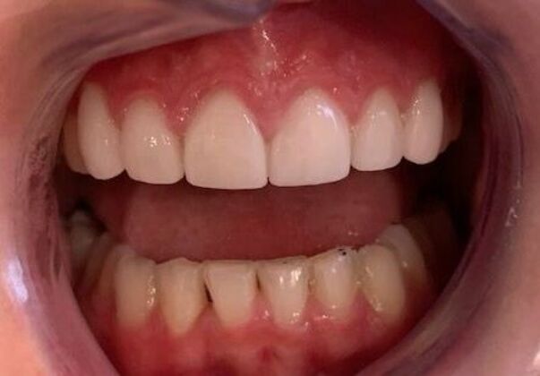 Veneers Case 2 - After
