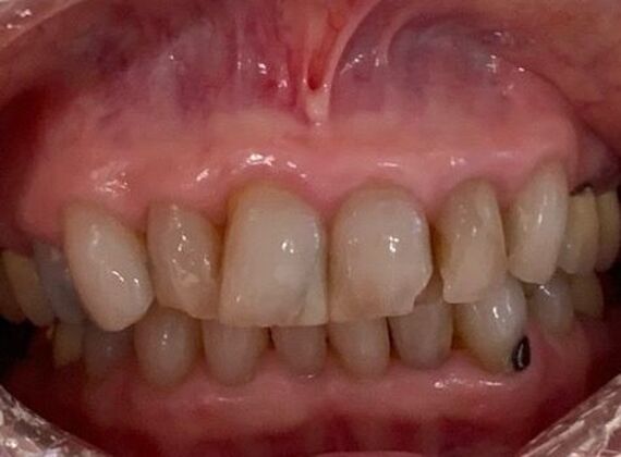 Crowns Case 4 - Before