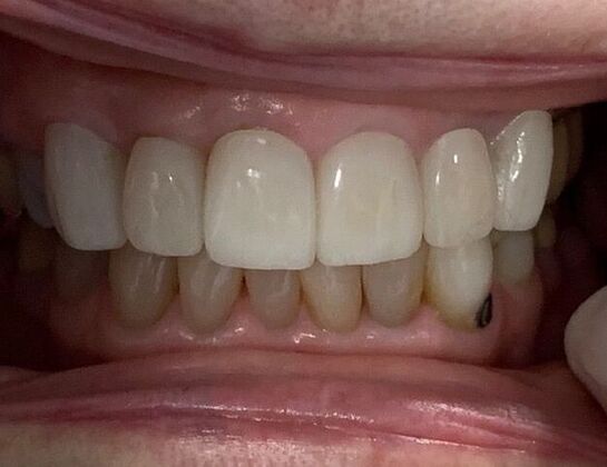 Crowns Case 4 - After