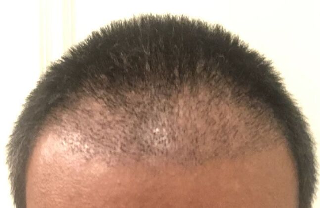 Hair Transplantation Case 2 - After