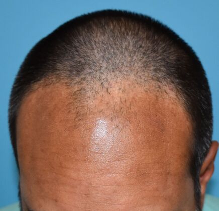 Hair Transplantation Case 2 - Before