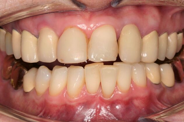 Implant Restorations Michelle - Before