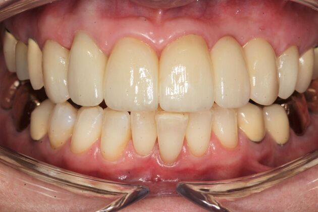 Implant Restorations Michelle - After