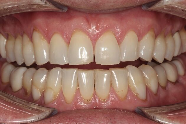 Veneers Peter - Before