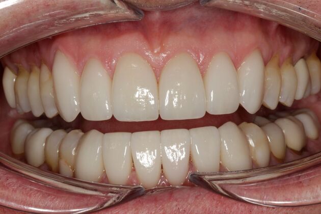 Veneers Peter - After