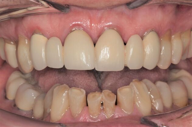 Crowns Richard - Before