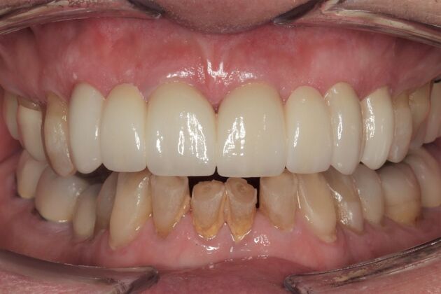 Crowns Richard - After