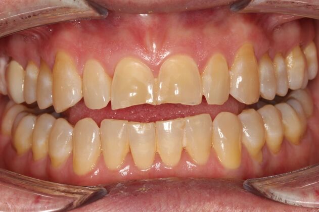 Veneers Richard - Before