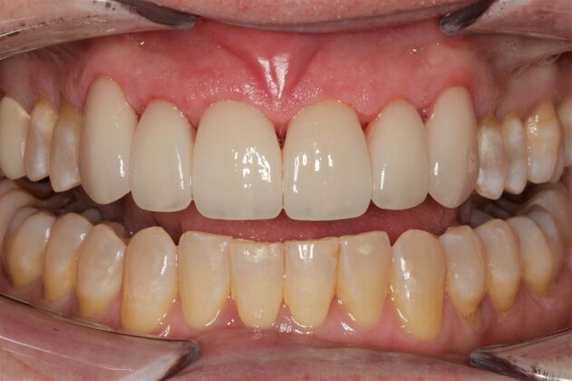 Veneers Richard - After