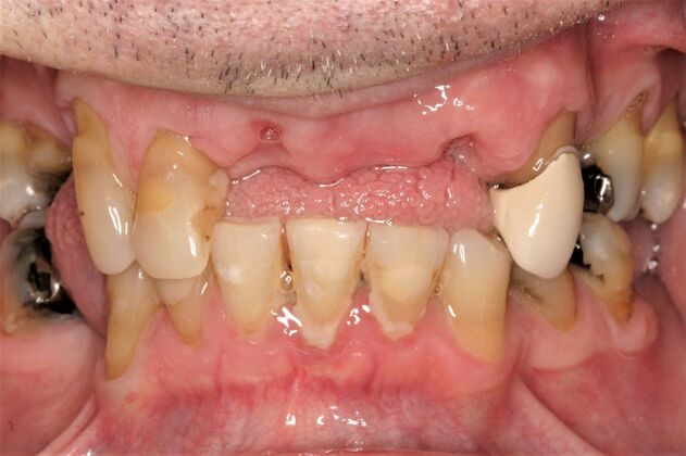 Implant Retained Overdentures Ronald - Before