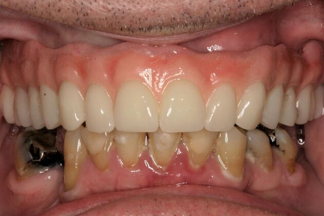 Implant Retained Overdentures Ronald - After