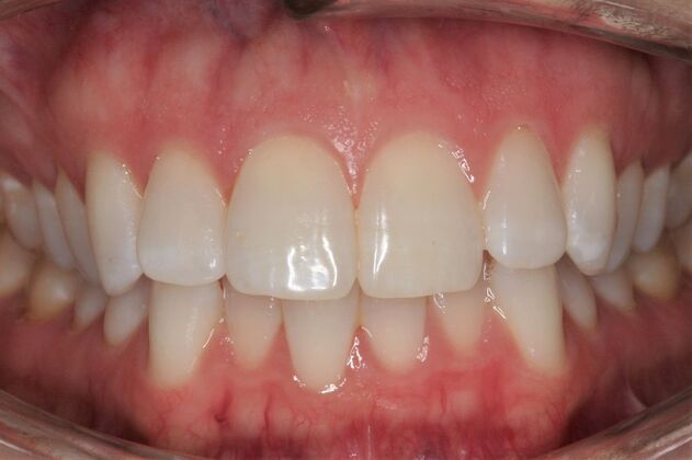 Orthodontics Sarah - Before