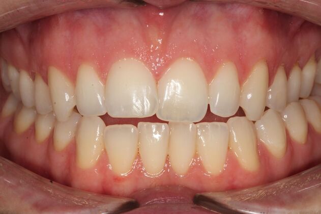 Orthodontics Sara - Before