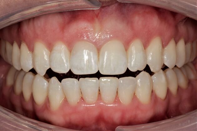 Orthodontics Tracey - After