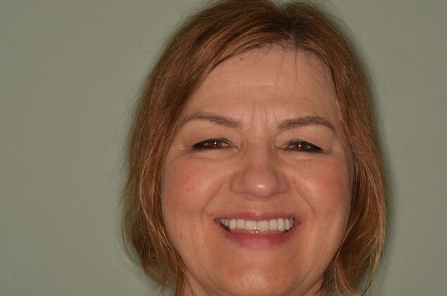 Porcelain Veneers: Case 29 - After Porcelain veneers