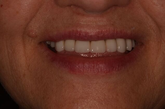 Porcelain Veneers: Case 29 - After Porcelain veneers