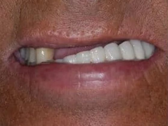 Dental Implants: Case 1 - Before Dental Implants