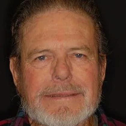 Crowns Case 4 - Before