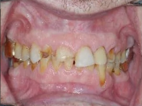 Crowns: Case 4 - Before Dental Crowns