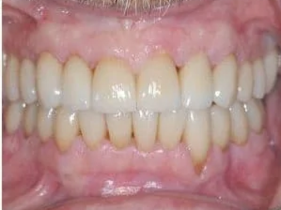 Crowns: Case 4 - After Dental Crowns