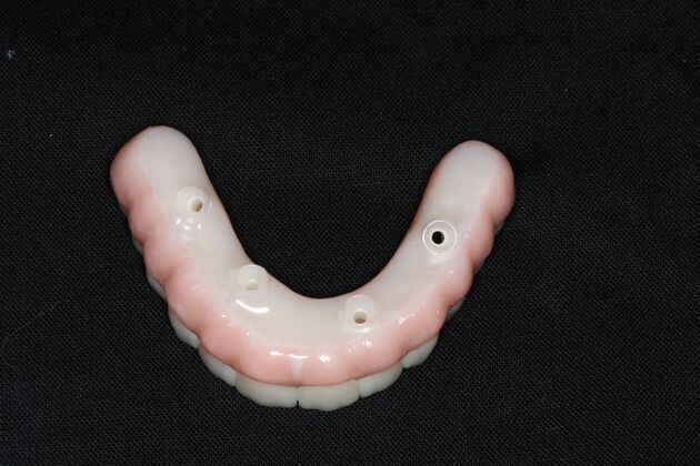 Teeth In A Day: Case 26 - Prosthetic