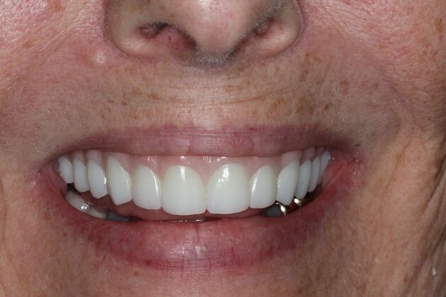 Teeth In A Day: Case 26 - After  All on 4