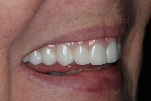 Teeth In A Day: Case 26 - Prosthetic in Place