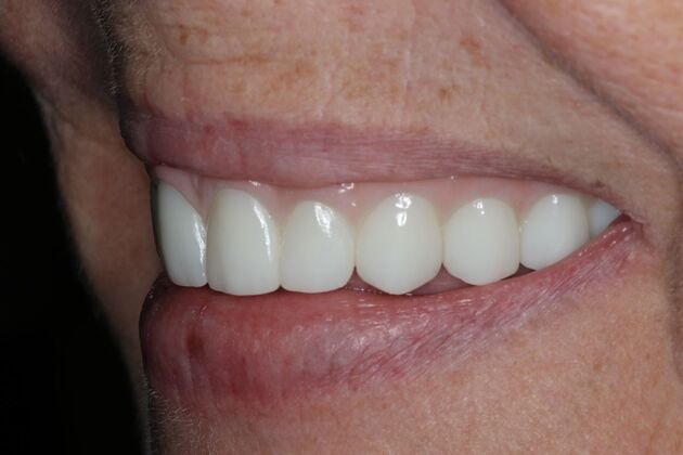 Teeth In A Day: Case 26 - Prosthetic in Place