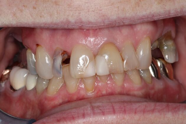 Teeth In A Day: Case 26 - Before