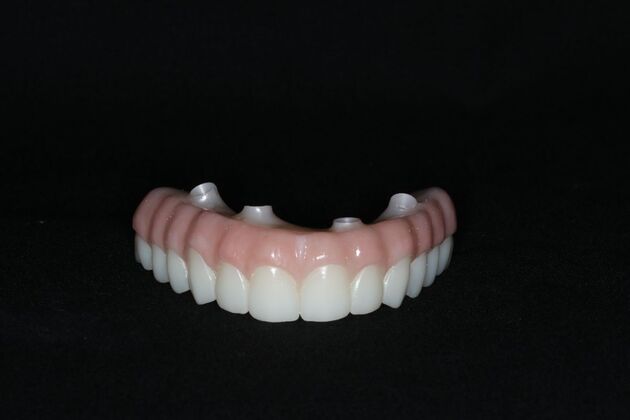 Teeth In A Day: Case 20 - Final Restoration