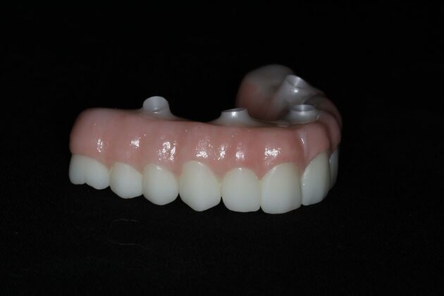 Teeth In A Day: Case 20 - Final Restoration