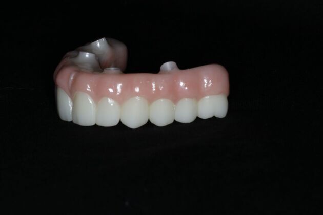 Teeth In A Day: Case 20 - Final Restoration