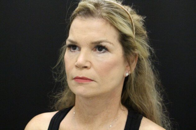 Face & Neck Lifts: Case 5 - After