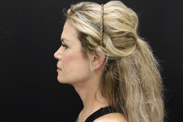 Face & Neck Lifts: Case 5 - After