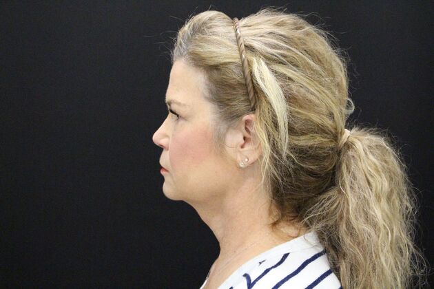 Face & Neck Lifts: Case 5 - Before