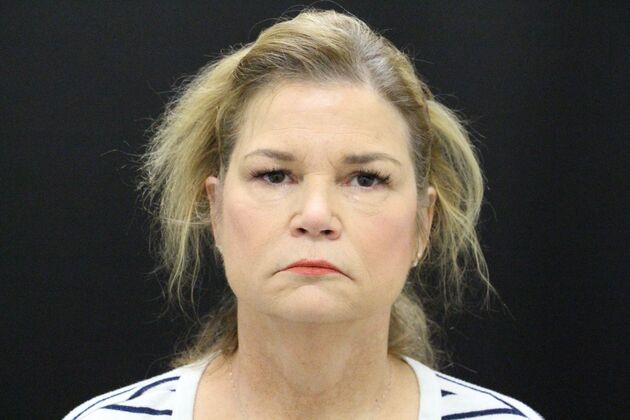 Face & Neck Lifts: Case 5 - Before