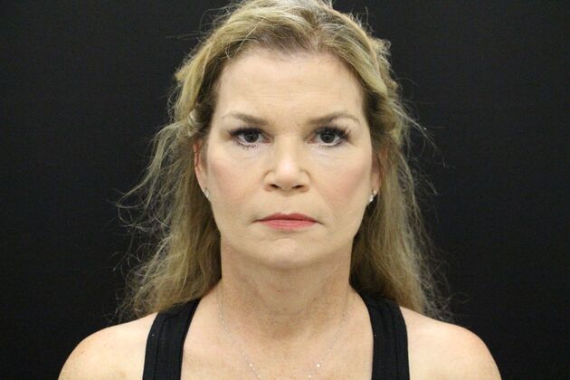 Face & Neck Lifts: Case 5 - After