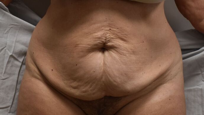 Tummy Tuck (Abdominoplasty): Case 367 - Before