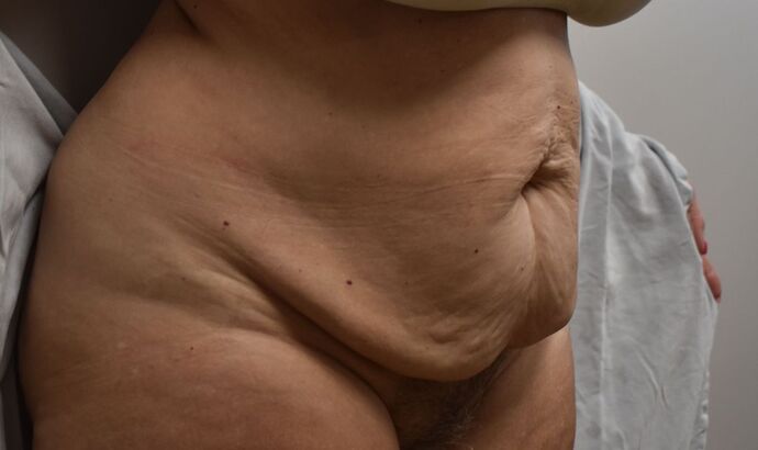 Tummy Tuck (Abdominoplasty): Case 367 - Before