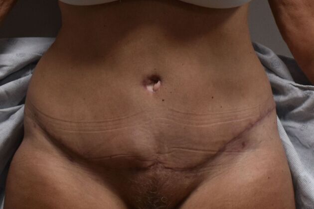 Tummy Tuck (Abdominoplasty): Case 367 - After